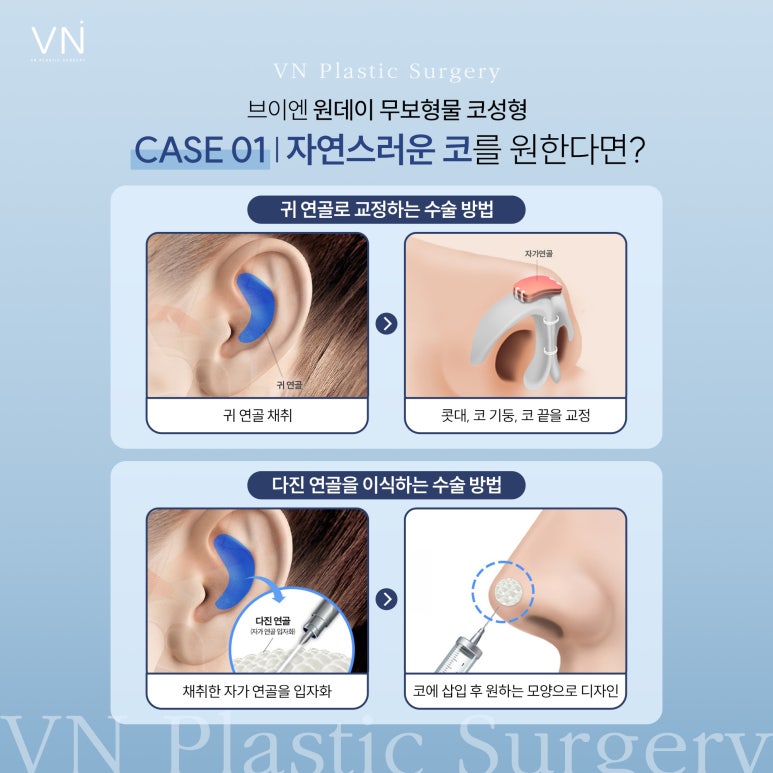 원데이 무보형물 코 성형은 어떤 수술인가요? 관련 이미지 3