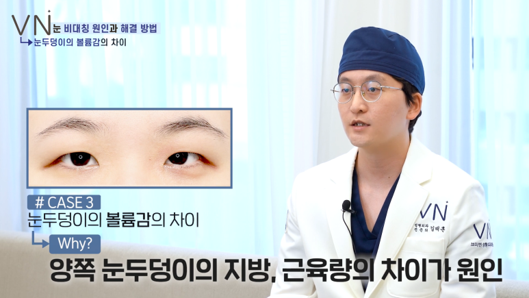 첫쌍꺼풀수술 전, 비대칭 짝눈의 원인과 해결법을 알아보자! 😀 관련 이미지 6