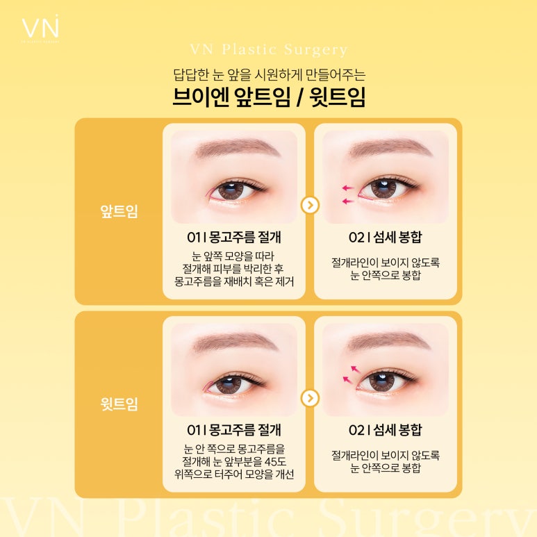 트임성형, 과하지 않고 자연스럽게 개선하는것이 포인트 관련 이미지 3