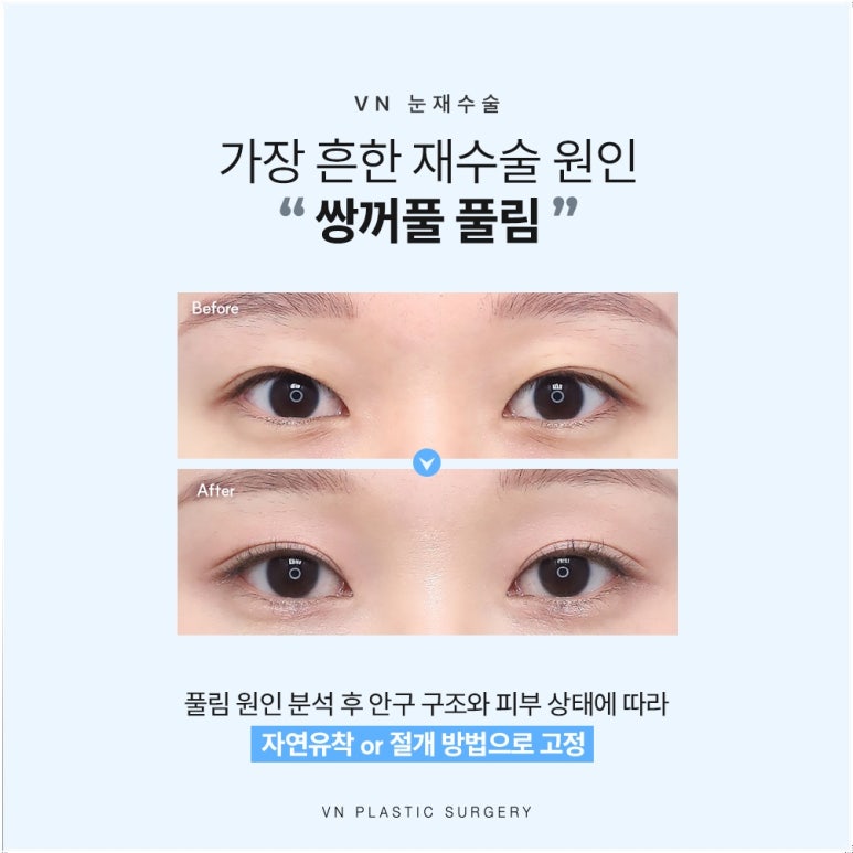 강남눈재수술, 원인이 다르면 방법도 달라집니다 관련 이미지 2