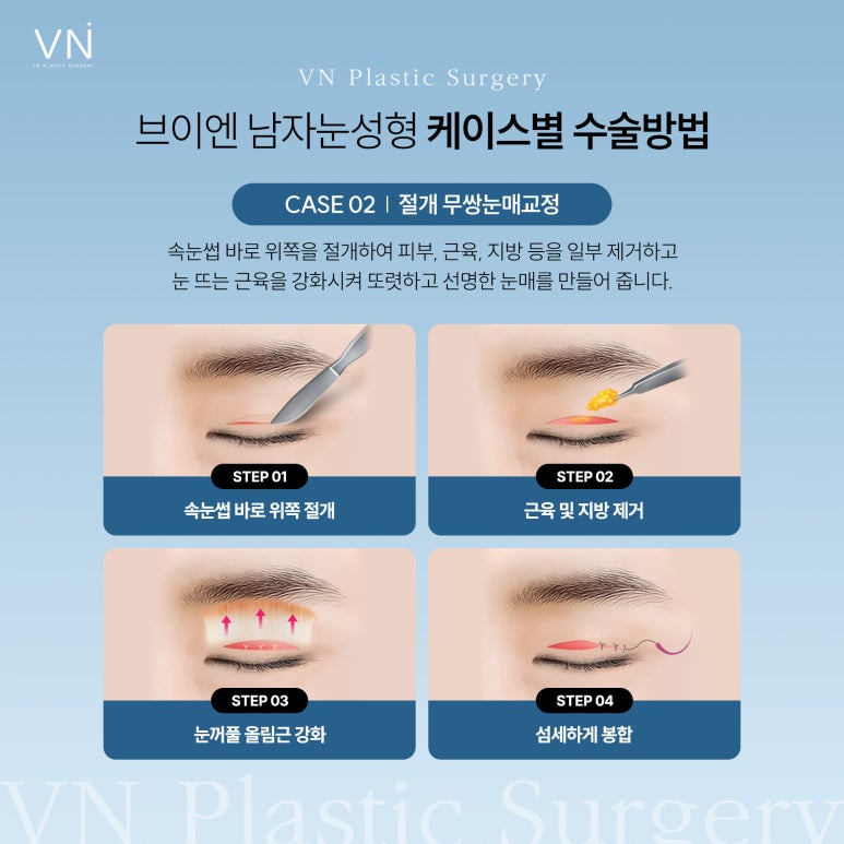 남자눈성형 자연스럽게 변화하는 것이 강점 관련 이미지 3