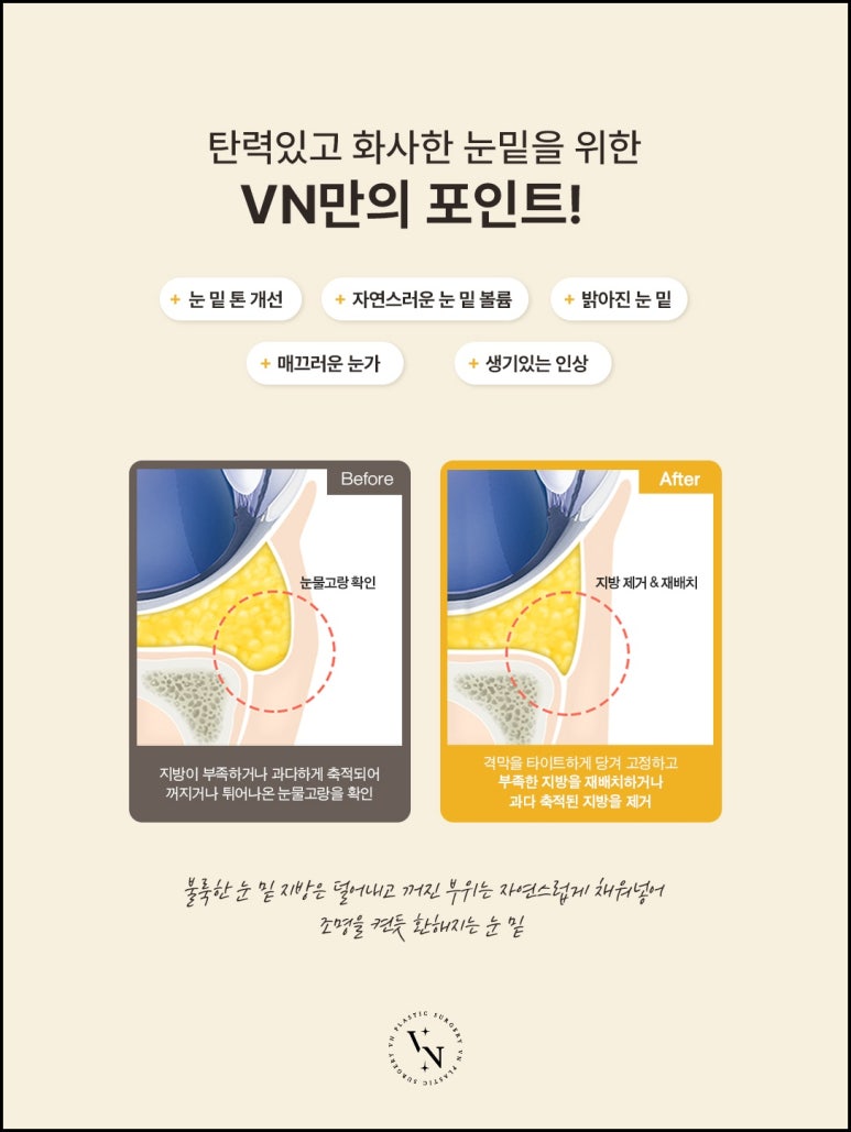 브이엔성형과 눈밑지방재배치 제대로 알기, 수술부터 유지기간까지 관련 이미지 2