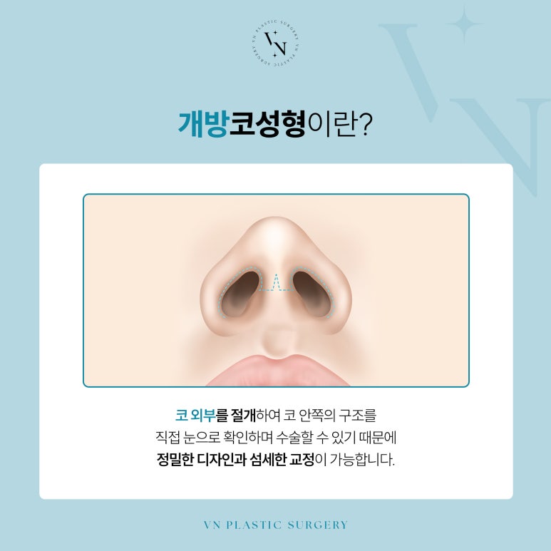 What Are the Differences Between Non-Open and Open Rhinoplasty? image 4