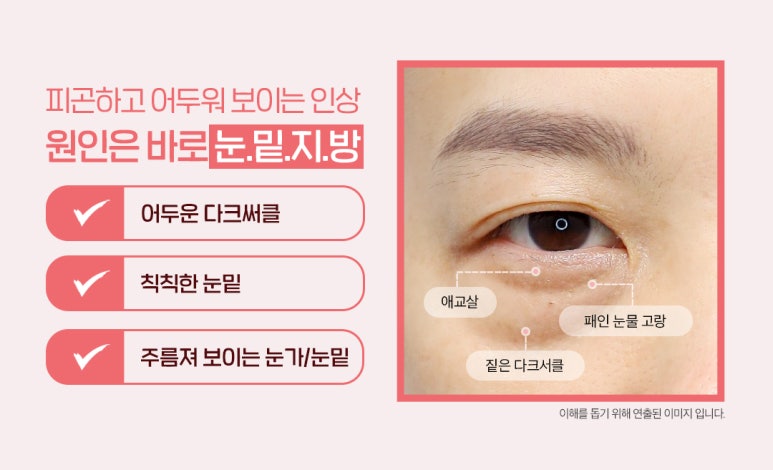 Lower Eyelid Fat Repositioning? Stop Hearing That You Look Tired Because of Dark Circles!🤚 image 3