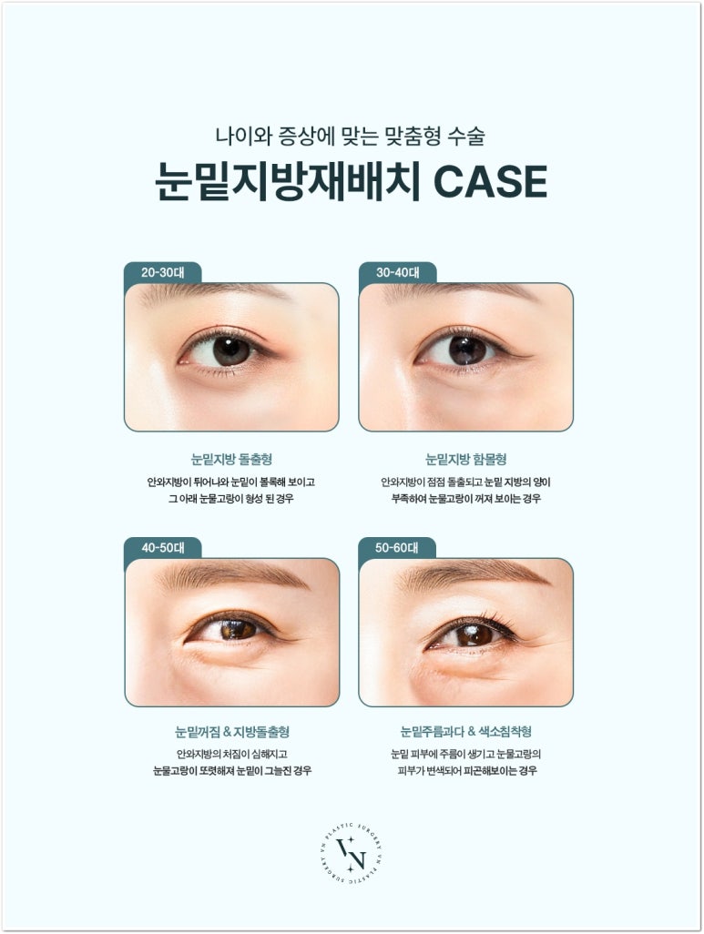 Best Place for Lower Eyelid Fat Repositioning: Should You Always Remove Lower Eyelid Fat? image 2