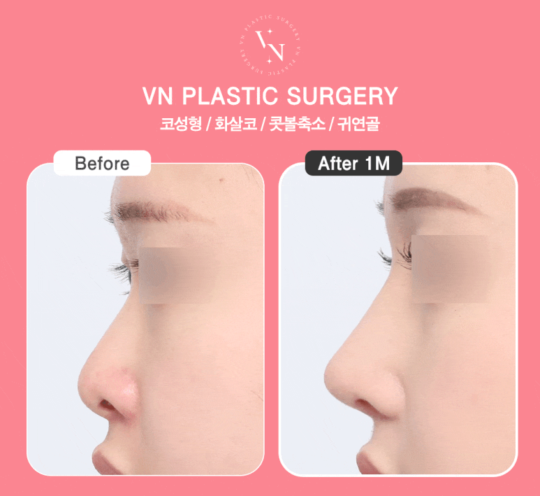 [Arrow Nose Correction in Sinnonhyeon/Gangnam] How to Fix a Nose That Looks Long and Change Your Impression ｜ VN Plastic Surgery image 4