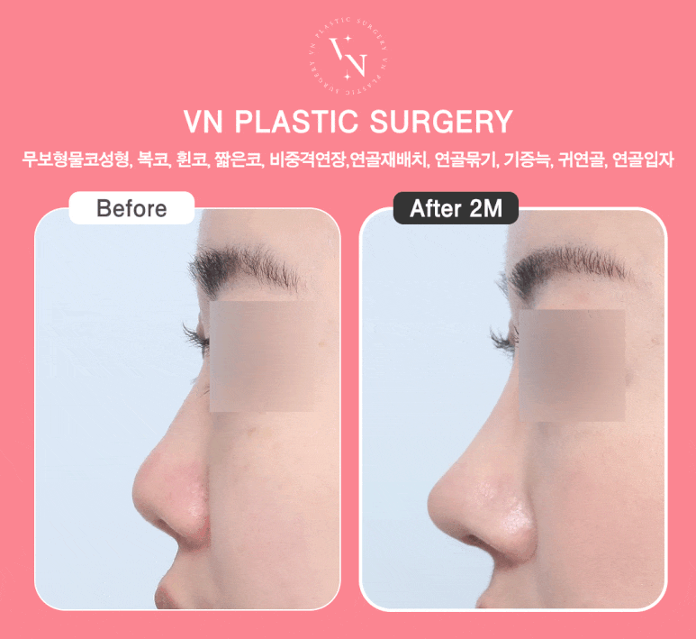 무보형물코성형으로 완성하는 자연스러운 변화, 강남역 성형외과 선택 노하우 관련 이미지 9