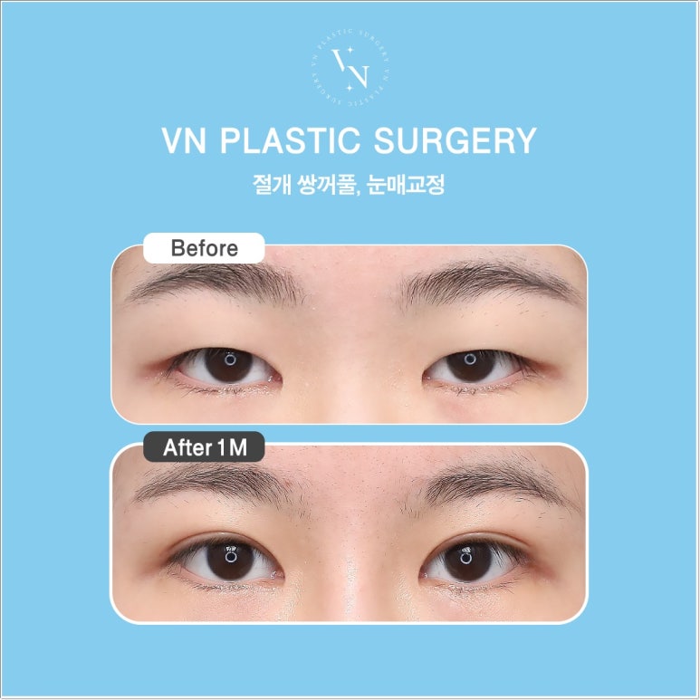 Double Eyelid Incision Surgery Review｜Do I Need Incisional Double Eyelid Surgery? image 5