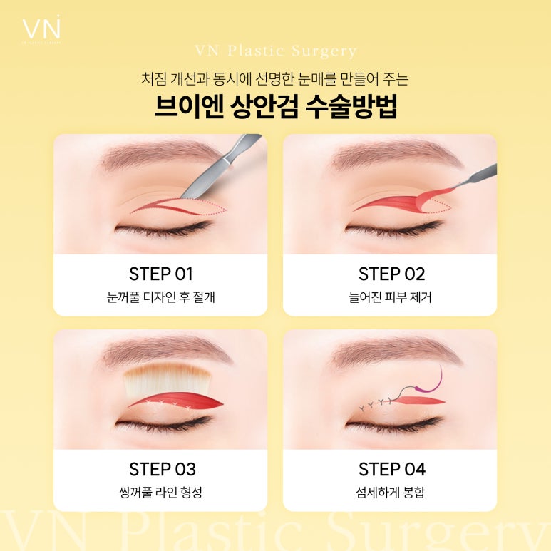 Upper Eyelid Surgery? Lower Eyelid Surgery? A Comparative Analysis of Eyelid Surgery for Middle-Aged Adults image 3