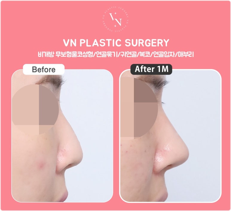 Cartilage Particle Rhinoplasty (Shasha Nose): Why Finely Mince the Cartilage? image 7