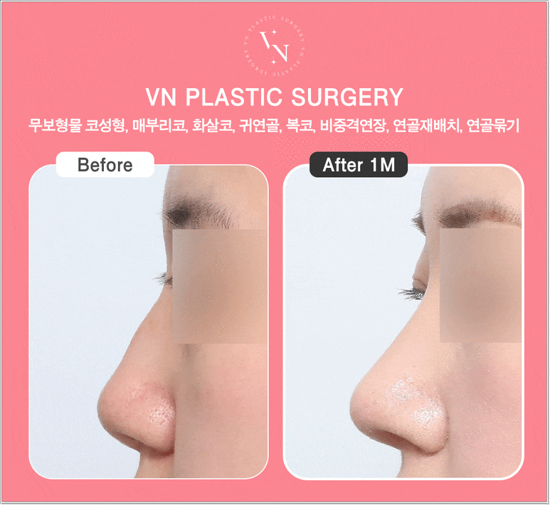 무보형물코성형 장단점, 무조건 보형물이 없는 게 좋을까? | 브이엔성형외과 관련 이미지 6