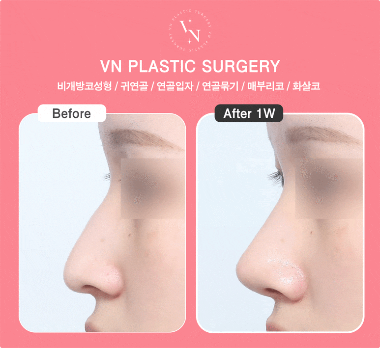 Why Does the Cost of Hump Nose Surgery Vary by Clinic? 5 Reasons for the Price Difference image 6