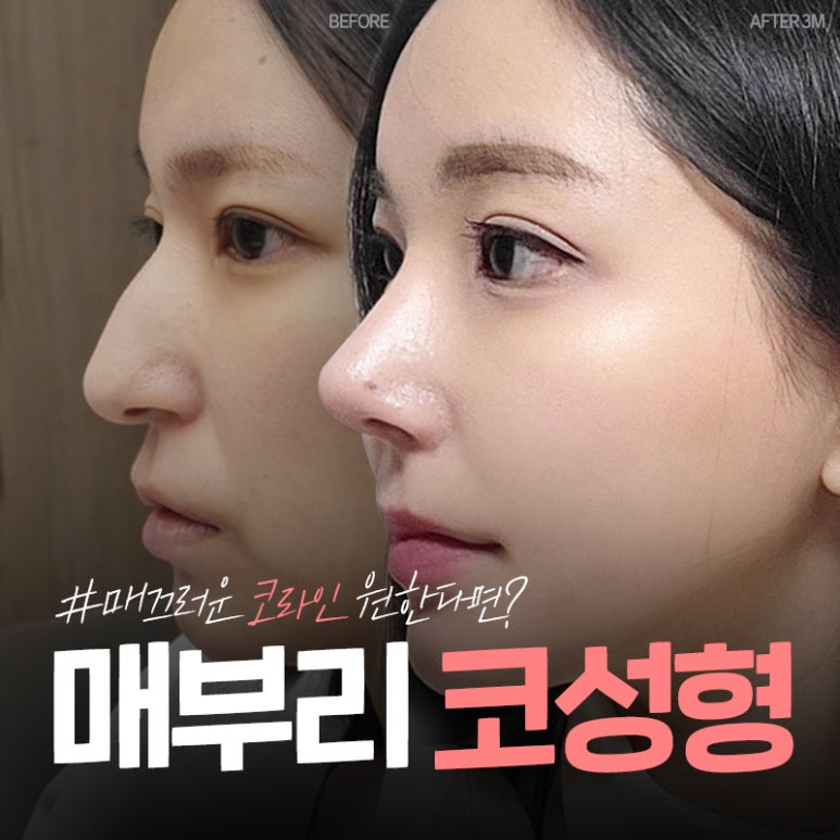 브이엔성형외과 제공｜매부리코교정 방법은? 관련 이미지 1