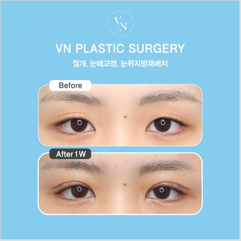Double Eyelid Incision Surgery Review｜Do I Need Incisional Double Eyelid Surgery? image 4