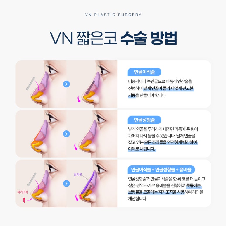Short Nose Surgery at a Plastic Surgery Clinic in Sinnonhyeon: Key Points for Restoring Facial Proportions image 4