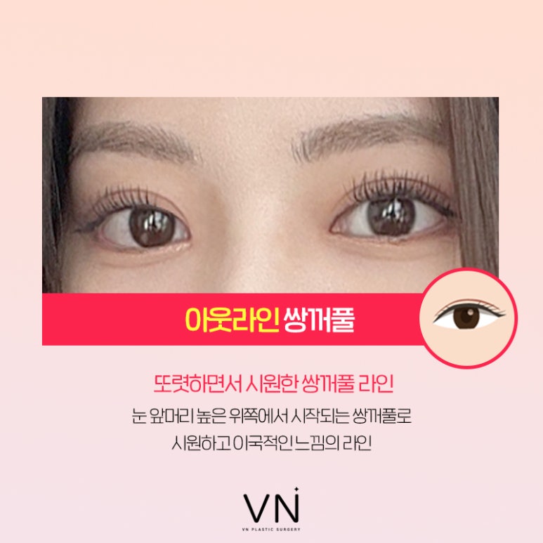 인라인? 아웃라인? 쌍꺼풀수술라인 종류 알아보기 (+연예인 쌍꺼풀) 관련 이미지 5