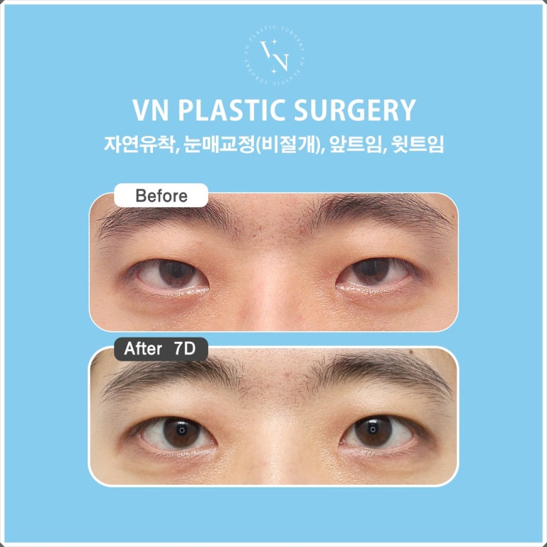 Male Eye Surgery: The Difference in Details That Create a Natural Eye Shape image 7