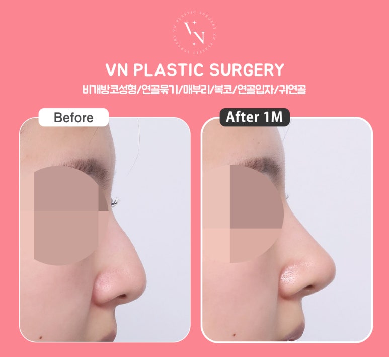 [Gangnam/Sinnonhyeon VN Plastic Surgery] CSAT Rhinoplasty Season: How to Create a Beautiful Nose Line Without Scars with Non-Open Rhinoplasty image 6