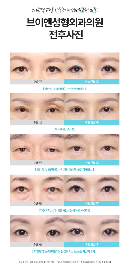 눈밑 처짐을 개선하는 신논현 브이엔성형외과 하안검수술 관련 이미지 4