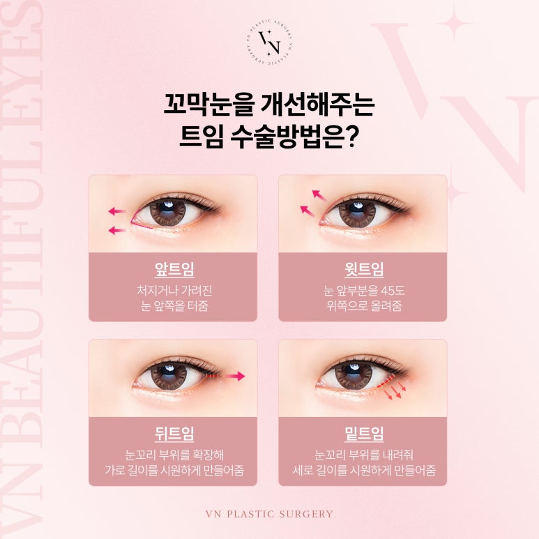 브이엔성형외과, 꼬막눈 개선하는 트임수술 관련 이미지 4