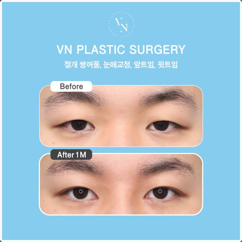 Male Eye Surgery: The Difference in Details That Create a Natural Eye Shape image 4