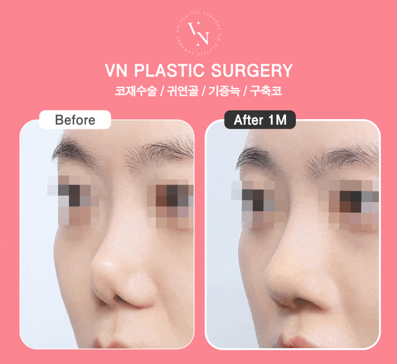Short Nose Surgery at a Plastic Surgery Clinic in Sinnonhyeon: Key Points for Restoring Facial Proportions image 9
