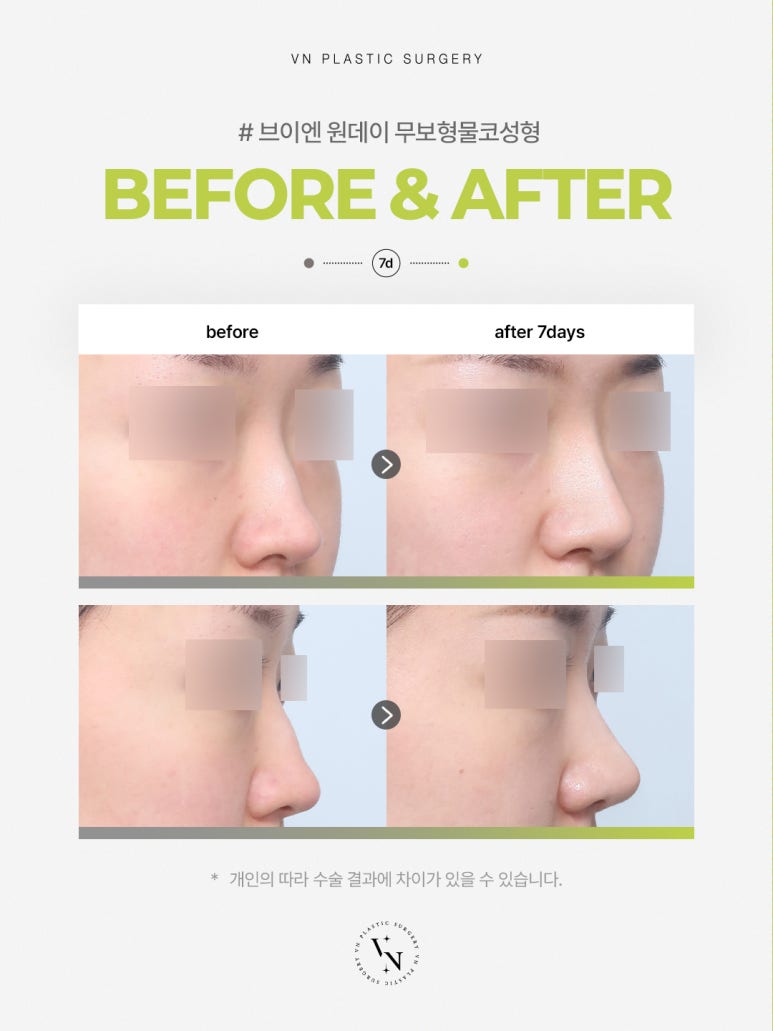 VN Plastic Surgery One-Day Implant-Free Rhinoplasty, Fast Recovery and Safety at the Same Time! image 2