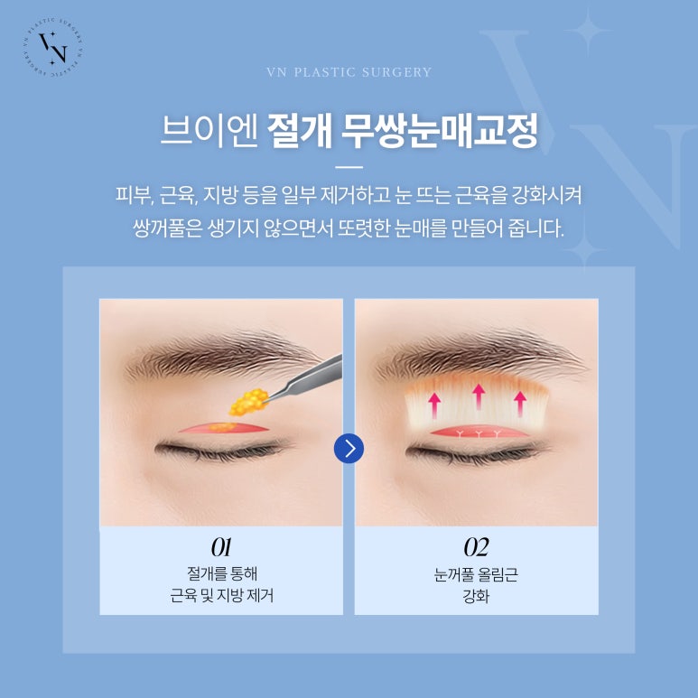 Male Double-Eyelid-Free Eye Surgery for a More Natural Eye Shape image 4