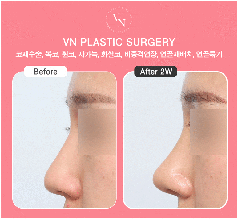 [코재수술잘하는곳] 원하는 코로 다시 바꿀 수 있을까? 관련 이미지 7