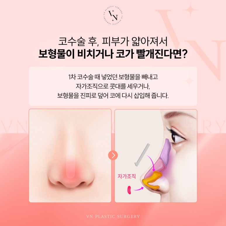 첫코수술보다 코재수술이 어려운 이유는 무엇인가요? 관련 이미지 4