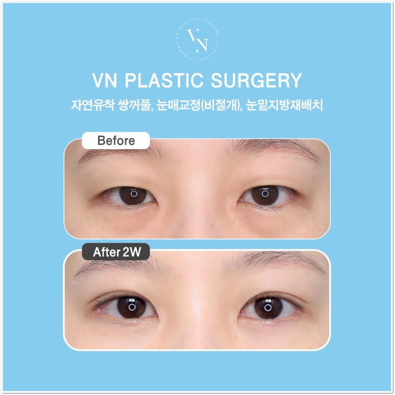 Best Place for Lower Eyelid Fat Repositioning: Should You Always Remove Lower Eyelid Fat? image 7