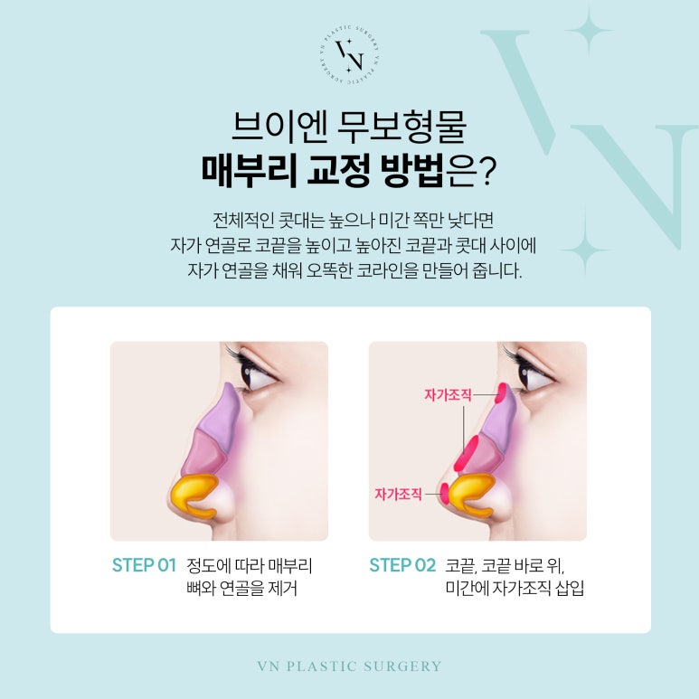 Is it possible to correct a hooked nose without silicone? image 5