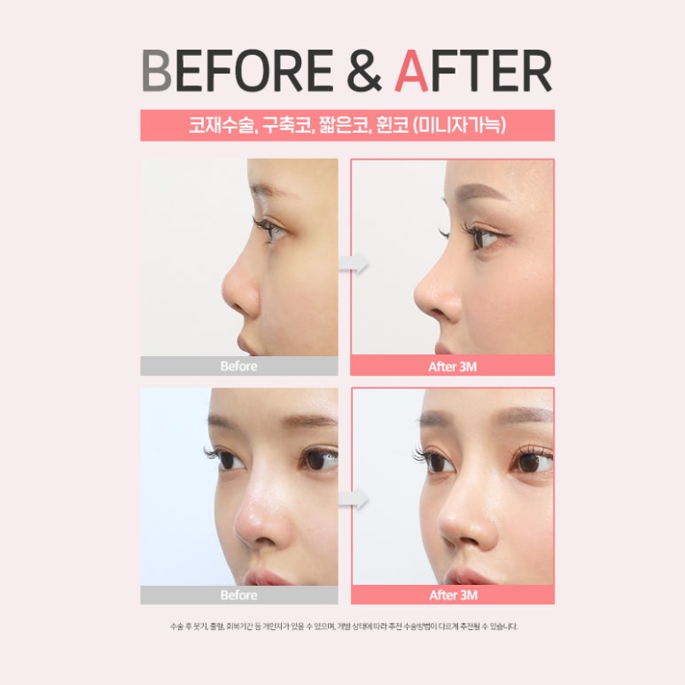 코성형수술 전이라면 클릭🖱 (feat. 수술재료 모아보기) 관련 이미지 9