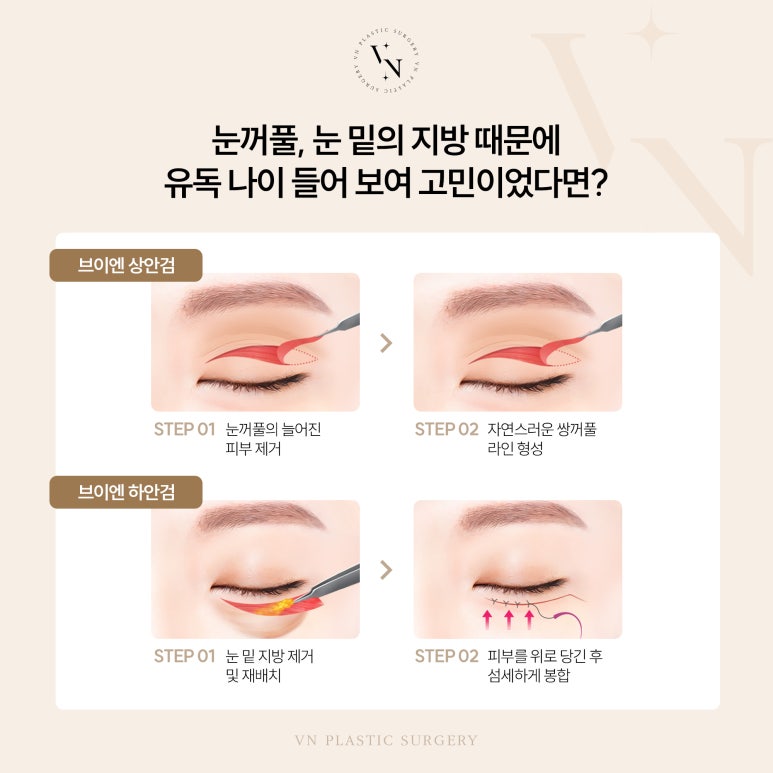 VN’s Upper and Lower Eyelid Surgery for a Youthful-Eye Look image 4
