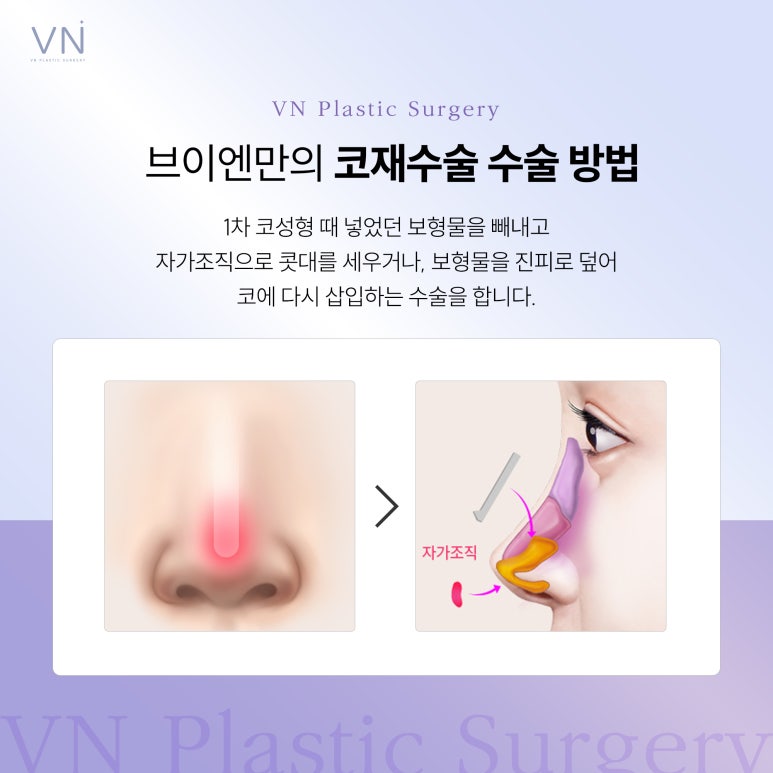 Should I Have a Nose Revision Surgery? image 6