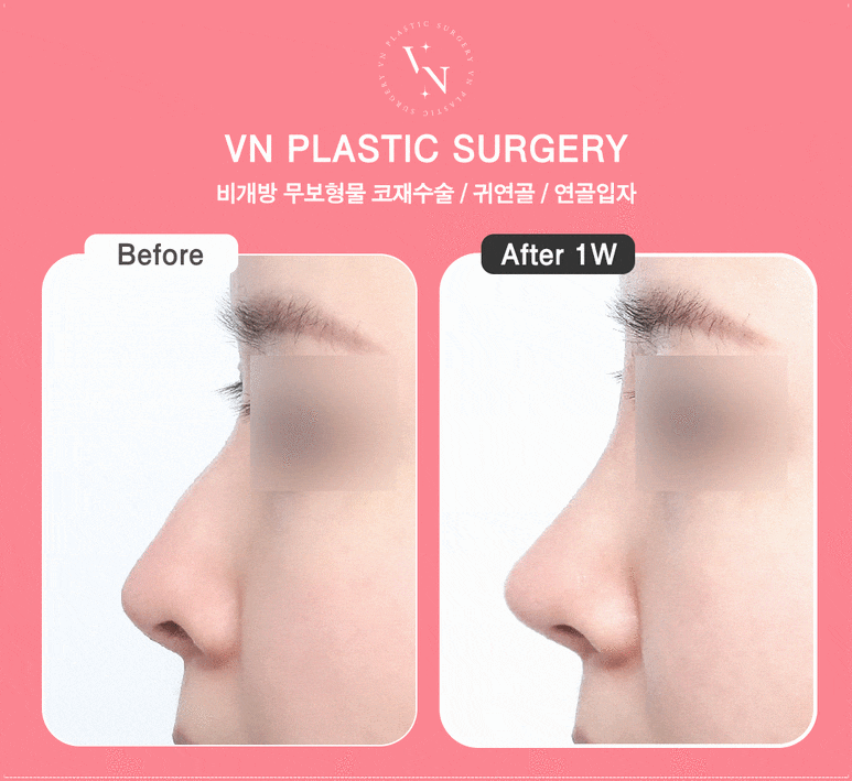 Looking for a Clinic for Natural-Looking Rhinoplasty? ShashaCo at VN Plastic Surgery Clinic image 6