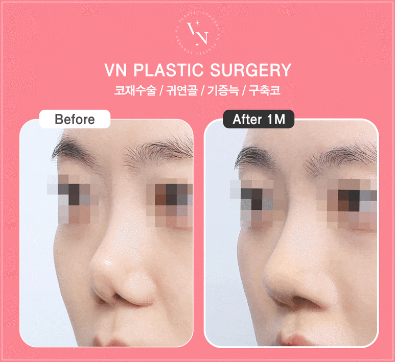 When Should Contracture Nose Revision Surgery Be Done? From Causes to Solutions (VN Plastic Surgery) image 4