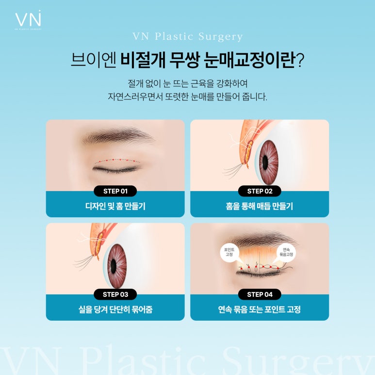 남자눈성형, 여자눈성형과는 어떤 차이점이 있나요? 관련 이미지 5
