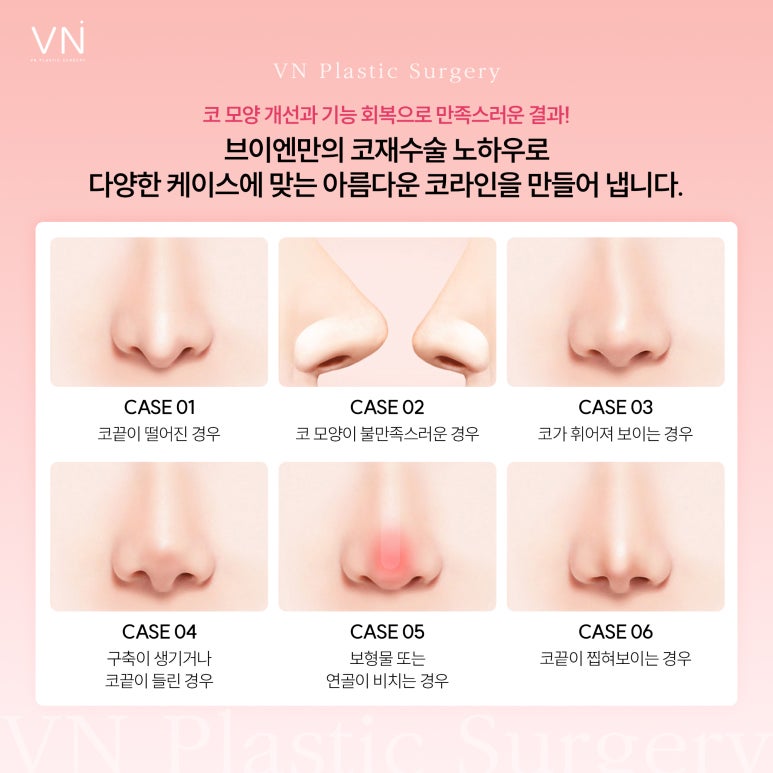 코재수술, 성공 확률을 높이려면? 관련 이미지 5
