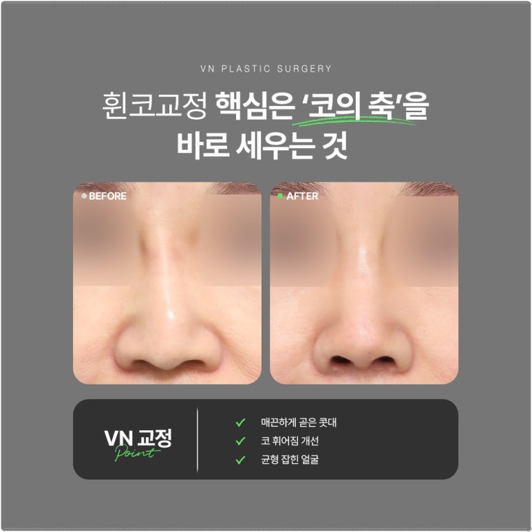 [VN Plastic Surgery] The Key to Correcting a Crooked Nose Is Identifying the Cause: Congenital or Acquired? image 5