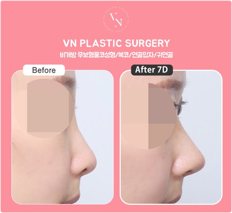 Cartilage Particle Rhinoplasty (Shasha Nose): Why Finely Mince the Cartilage? image 5