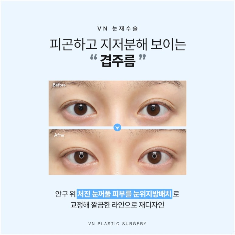 강남눈재수술, 원인이 다르면 방법도 달라집니다 관련 이미지 4