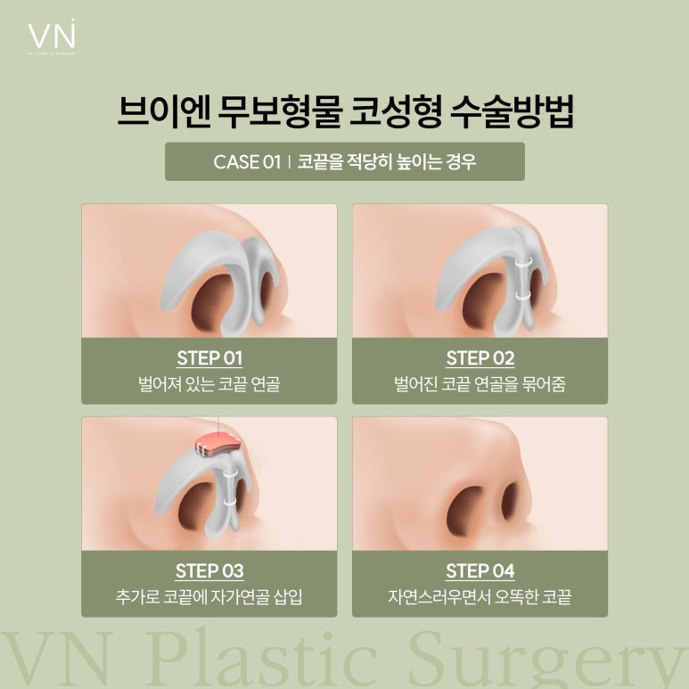 If you’re afraid of complications from nasal implants, implant-free rhinoplasty image 3