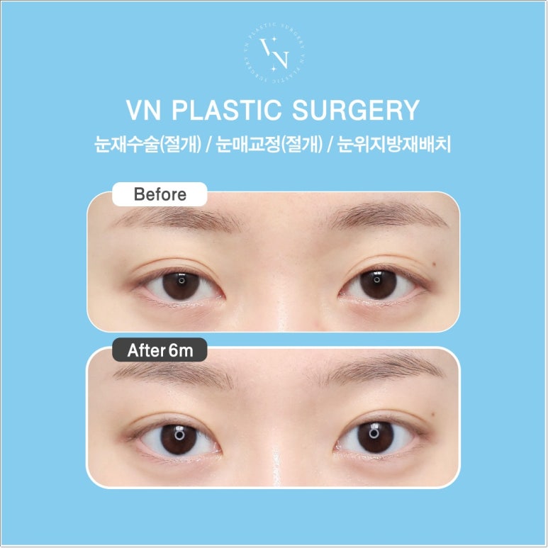 Double Eyelid Incision Surgery Review｜Do I Need Incisional Double Eyelid Surgery? image 7