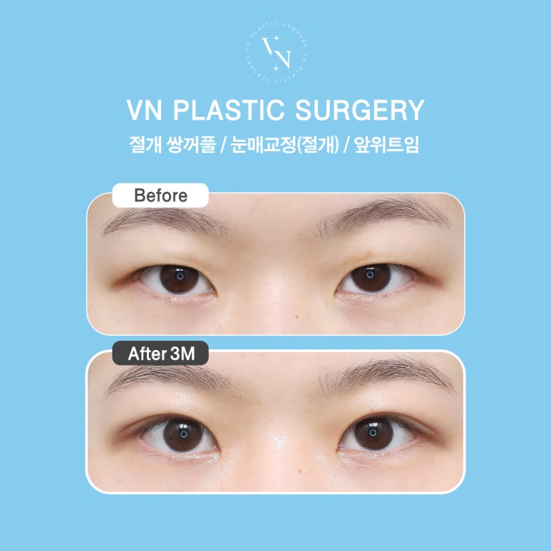 [Gangnam/Sinnonhyeon VN Plastic Surgery] Post-College Entrance Exam Double Eyelids Surgery Is Timed Perfectly Now! image 7