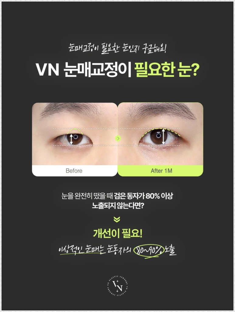 How Eyelid Correction Changes the Eyes: Comparison of Incision and Non-Incision Methods and Recovery Time image 2