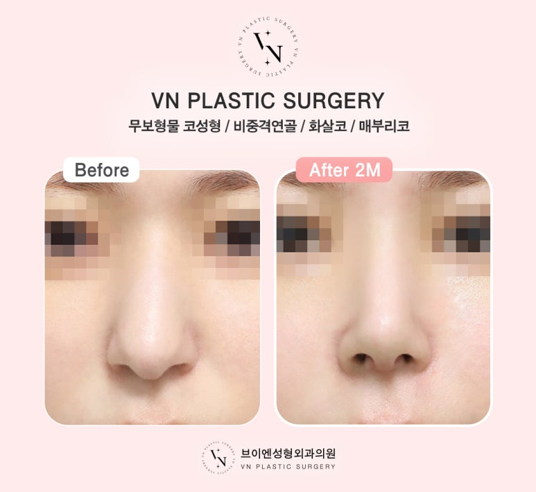 VN Plastic Surgery One-Day Implant-Free Rhinoplasty, Fast Recovery and Safety at the Same Time! image 6