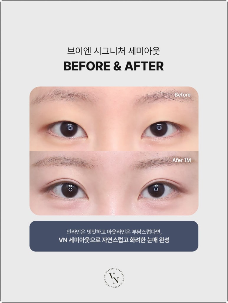 VN Plastic Surgery: If the Inline Looked Too Constricted and the Outline Felt Too Dramatic image 3