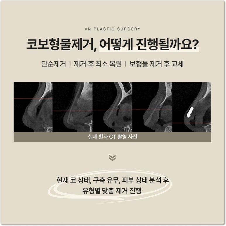 브이엔성형외과 코보형물제거 비용과 수술 후 코 모양 변화 관련 이미지 6