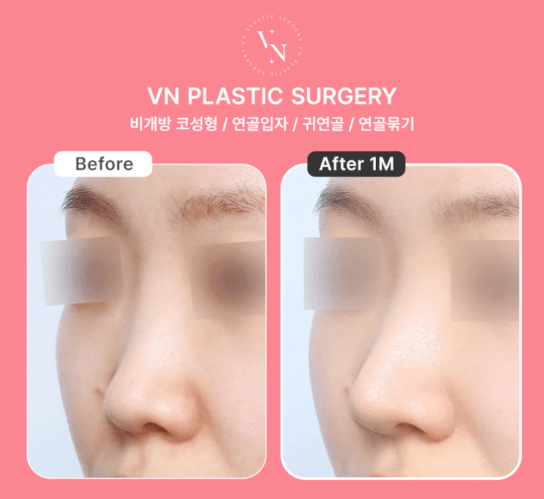 Closed Rhinoplasty Using Autologous Cartilage, Naturally Completed with VN Plastic Surgery’s ShashaKo ✨ image 5